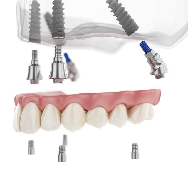 盈緯達(dá)旗下ABT種植體以德國精工技術(shù)引領(lǐng)口腔種植革新:種植

